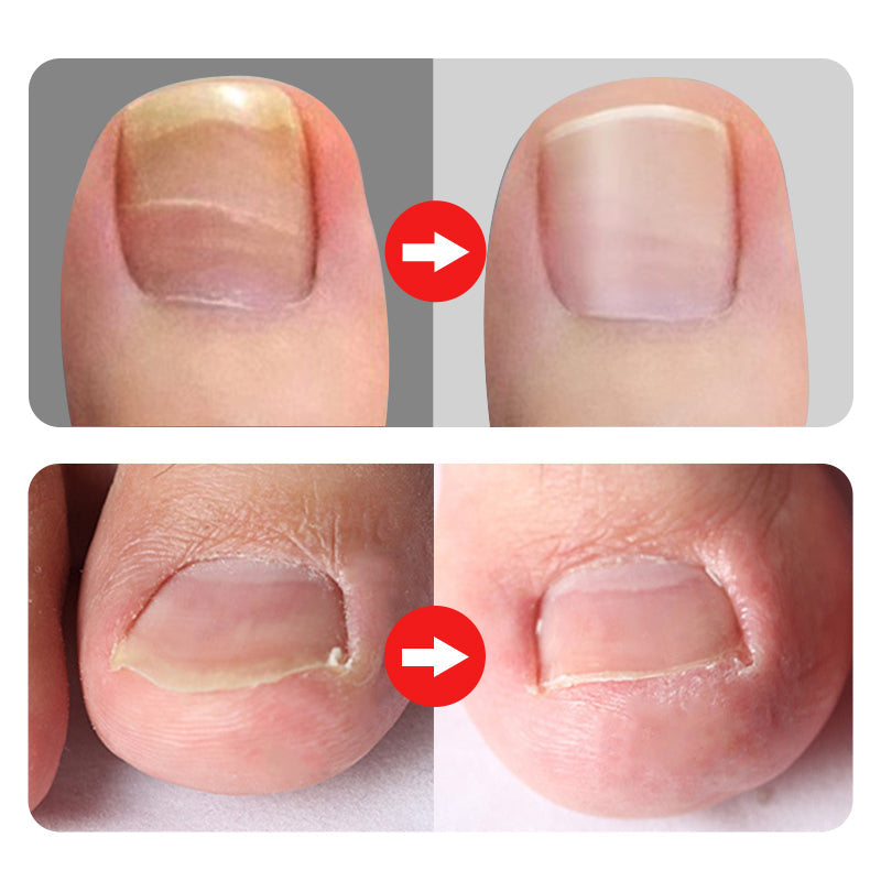 🔥Vente à chaud 50 % de réduction🔥Coupe-ongles professionnels pour ongles incarnés 7 pièces