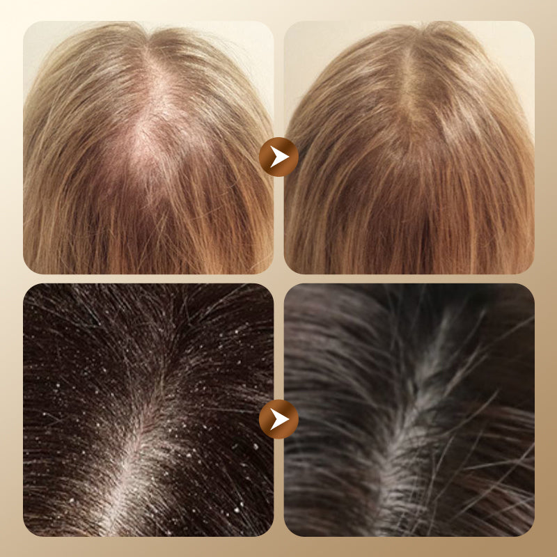 🔥55% de réduction🔥Shampoing Nourrissant et Anti-pelliculaire à Base de Plantes🌿